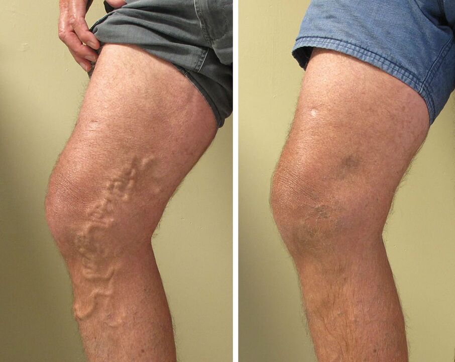 Vasaxal gel use experience