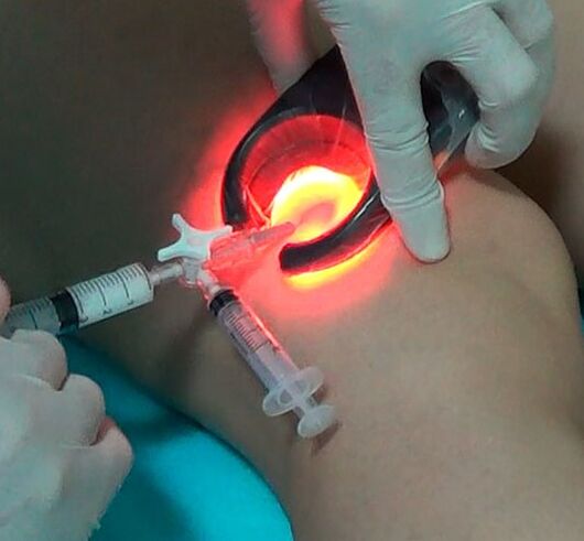 Varice treatment