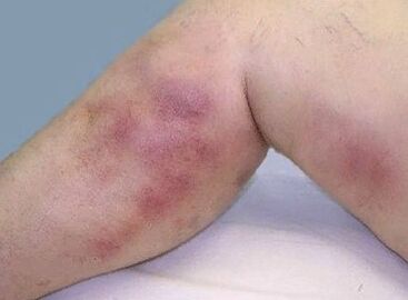 Varicose complications