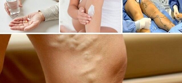 Varice treatment