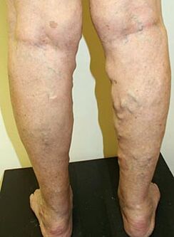 Varices on the legs