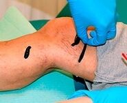 Blood for varicose veins