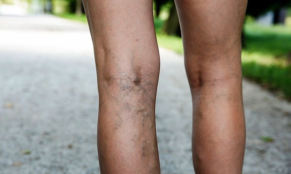 Extended veins on the legs