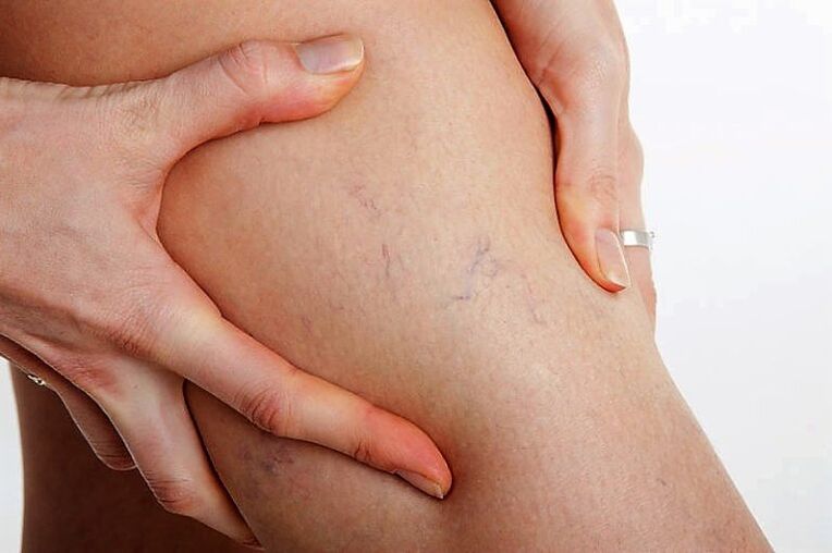 Varica grid on the leg