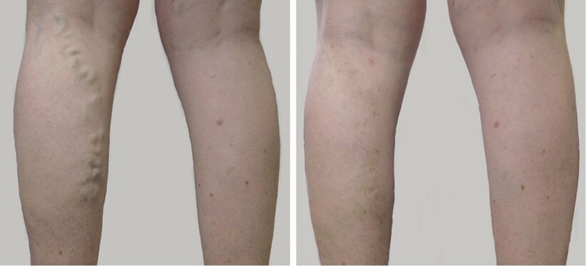 Before and after treatment