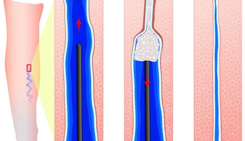 Introduction of sclerosing sclerotherapy