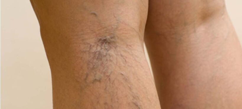 Varices on the legs