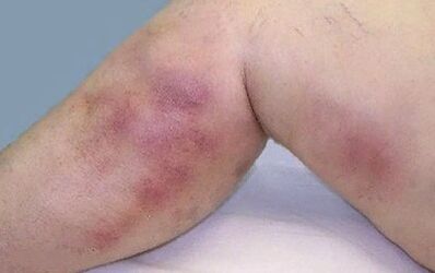 How varicose veins manifest