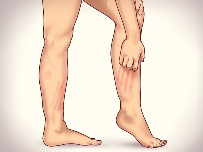 6 non -obvious signs of varicose veins