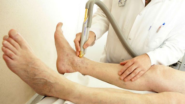 varicose veins on the inside of the legs