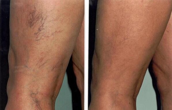photos before and after treatment of varicose veins